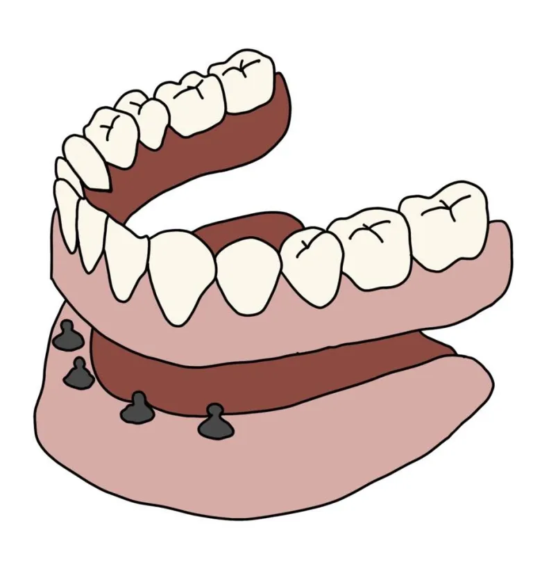 Illustration of an implant-retained overdenture