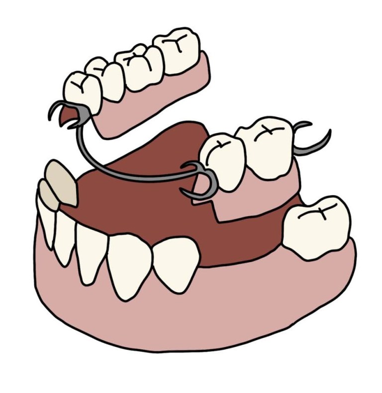 Illustration of a new partial denture with clasps