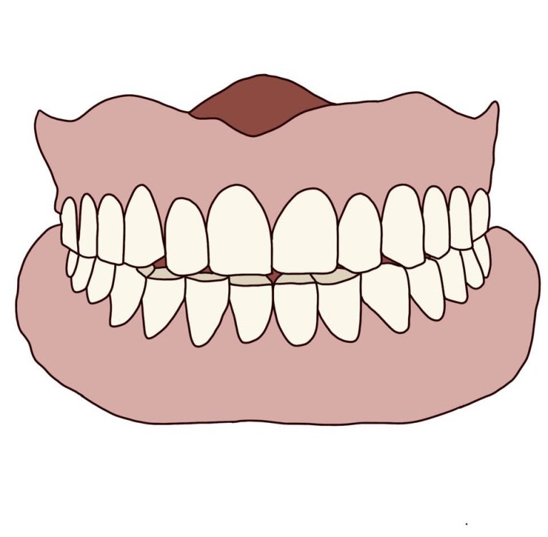 Illustration of a new complete denture